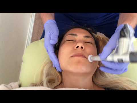 Procell Microchanneling in 2 Minutes