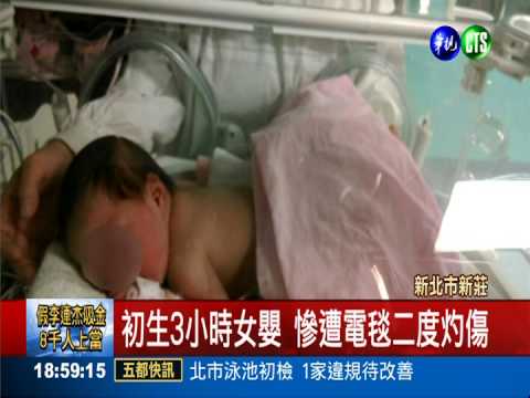 婦產科電毯燙人! 初生嬰二度灼傷