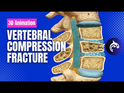 Lumbar Stenosis 3D Animation
