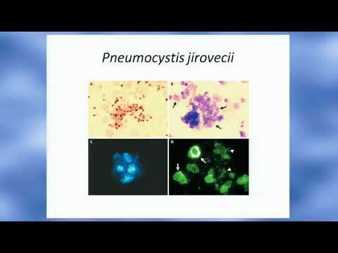 Dolori articolari e debolezza Trattamento di laser articolazioni osteocondrosi