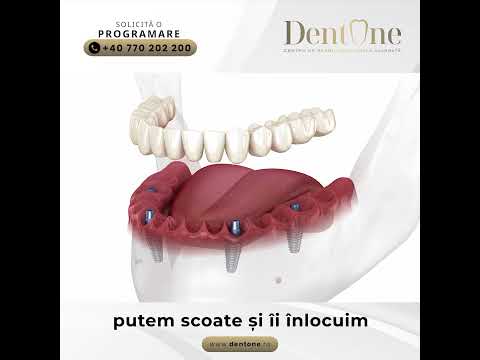 Structuri dentare din titan sau zirconiu? Care este diferența?