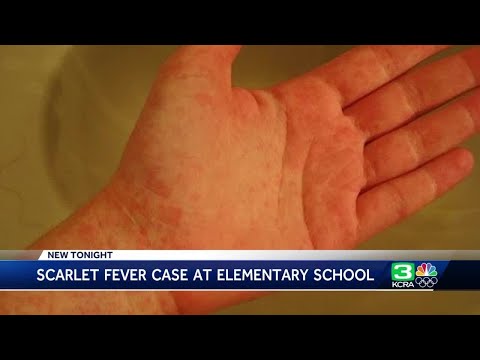 Case of scarlet fever confirmed at Elk Grove elementary school