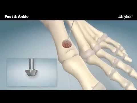 Stryker Foot and Ankle | Anchorage® CP Plating Systems Animation