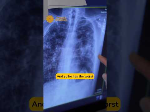 Heightened silica dust exposure may be causing black lung in miners at an earlier age #shorts