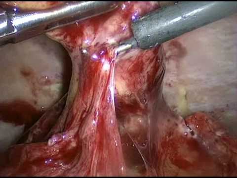 Laparoskopowa appendektomia z powodu ostrego zapalenia wyrostka z naciekiem okołowyrostkowym