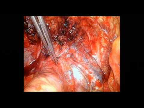 Retropubic Prostatectomy - Intrafascial Nerve-Sparing Technique 