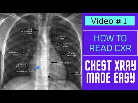 Chest Xray Made Easy || How to read CXR || Video 1