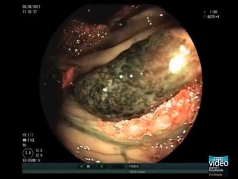 Giant Colonic Angiodysplasia