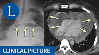 A purulent hydropneumopericardium causing cardiac tamponade