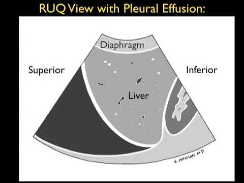 Ultrasound Detection of Pleural Fluid