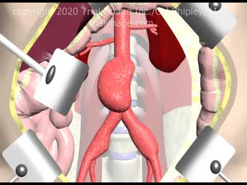 Aortoiliac Graft for Abdominal Aortic Aneurysm (AAA) Animation by Cal Shipley, M.D.