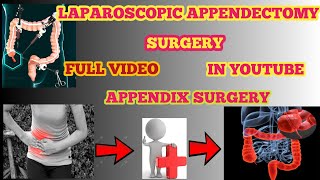 Laparoscopic Appendectomy Step by Step | Appendix Surgery Explained! Appendix Symptoms!OT WORK STAR 
