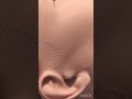 Facelift Procedure Medical Animation Video In 3D Health Youtubeshorts
