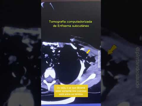 Tomografia Computadorizada Enfisema Subcutâneo 🫁