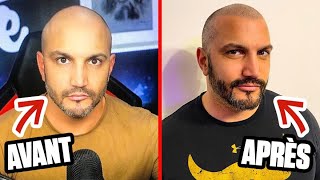 LA DERNIÈRE CHANCE POUR LES CHAUVES ! LA TRICOPIGMENTATION !