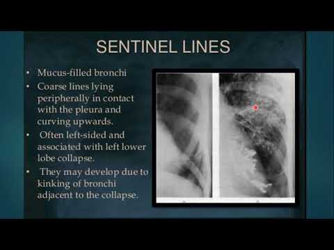 chest X ray, what to look for, part II