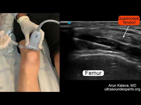 Ultrasound Guided Intra-articular Knee Injection