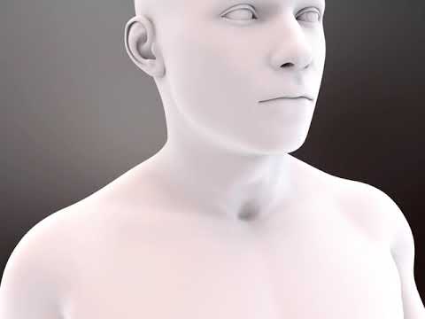 Transcatheter Mitral Valve Implantation