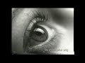 Patanol Allergy Medication 2001 Commercial