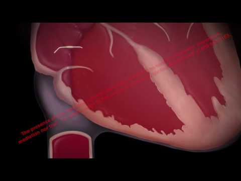 IVC Filter Public Awareness Animation | Mass Tort