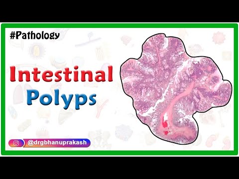 Intestinal polyps : Pathology lectures for fmge and neet pg