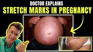 Doctor explains STRETCH MARKS in PREGNANCY - including signs, clinical photos, causes, treatment!
