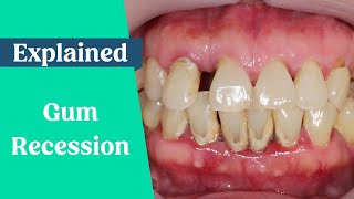 What causes gum recession & how to stop receding gums?