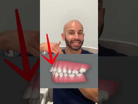Overbite Correction with Invisalign: Our Smile Design Plan