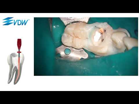 VDW Dental · GUTTAFUSION im klinischen Einsatz / clinical use (DE & EN)