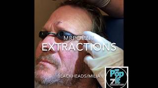 Blackhead extractions. Milia extractions. Multiple pops. Big squeeze. Acne surgery. MrPopZit.