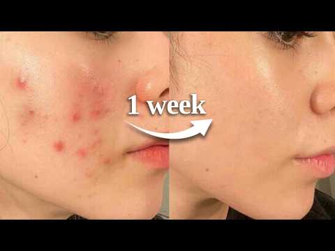 how to HEAL YOUR SKIN BARRIER in 1 week *naturally*