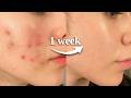 How To HEAL YOUR SKIN BARRIER In 1 Week Naturally