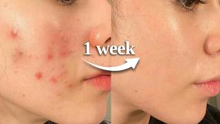 how to HEAL YOUR SKIN BARRIER in 1 week *naturally*