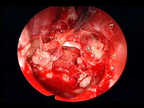 Duraseal Sellar Closure In Cystic Adenoma