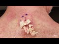 Cyst (Grits) Pop and Squeeze From Upper Back