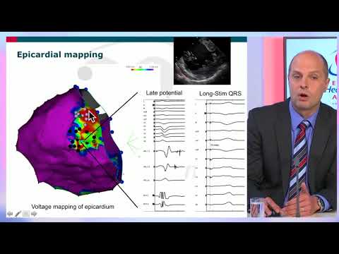 EHRA free webinar: New mapping tools for VT ablation