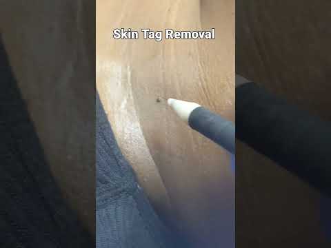 Skin Tag Removal On Her Neck using the Skin Classic Electro Cauterization machine.