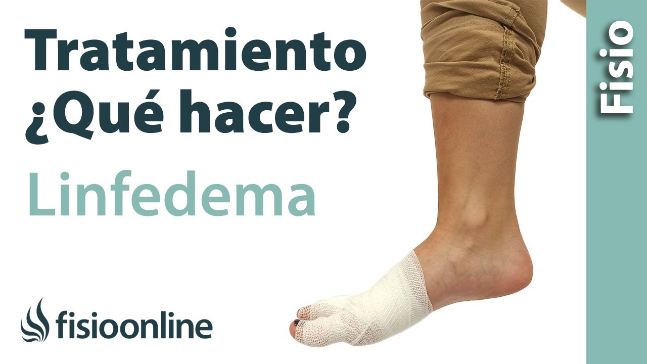 TRATAMIENTO para el LINFEDEMA🦵🏻¿Qué hacer? 🤔
