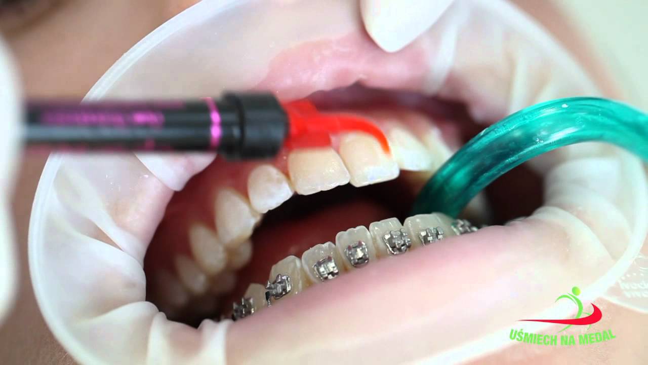 Jak wygląda wizyta w gabinecie ortodontycznym i w jaki sposób montuje się aparat.