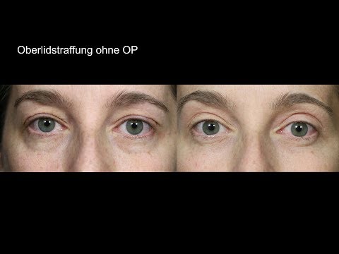 Augenlidstraffung ohne OP - Vorher Nachher Fotos (besser als Plasma Pen!)