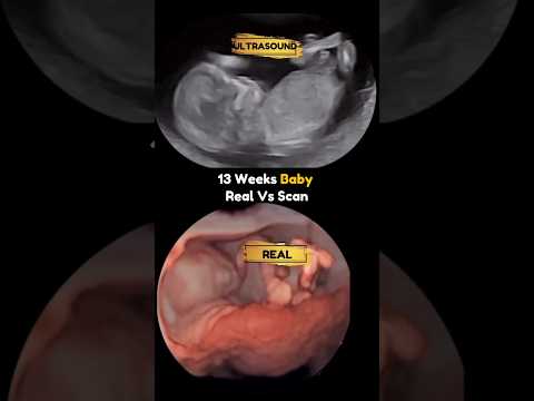 13 Weeks Baby Playing 😍 Real Fetoscopy Vs Ultrasound Video