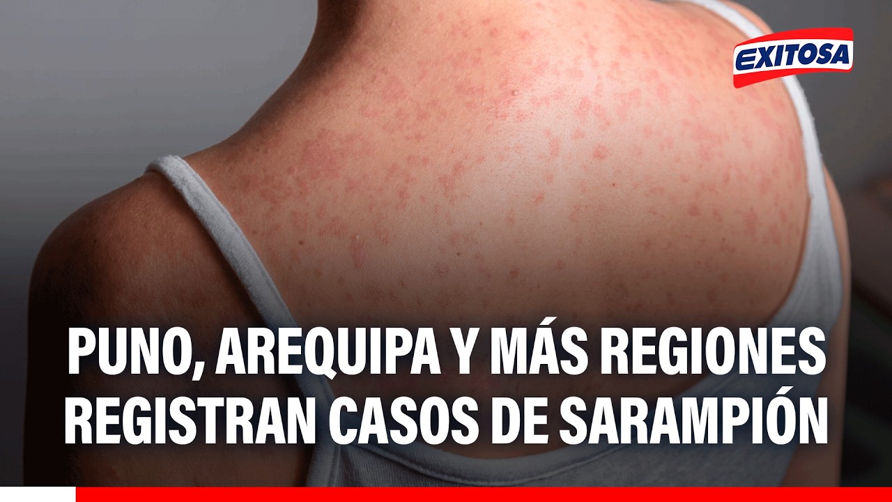 🔴🔵 Puno, Arequipa y más regiones registran casos de sarampión, advierte Minsa