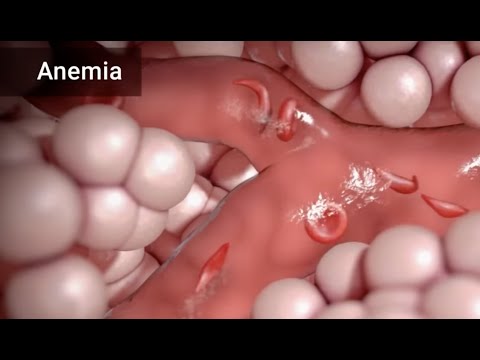 Treatment for Sickle Cell Anemia