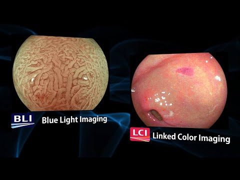 LCI e BLI para Phát Hiện e Chẩn Đoán Ung Thư Sớm Dạ Dày - Prof.