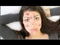 How to Get Rid of Acne Overnight! (Guaranteed less ...