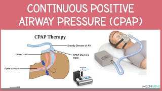 Continous Positive Airway Pressure (CPAP): Indications, Physiology, Settings and Contraindications