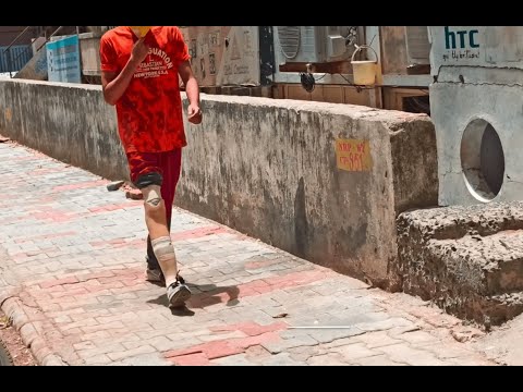 Below Knee Prosthesis Legs