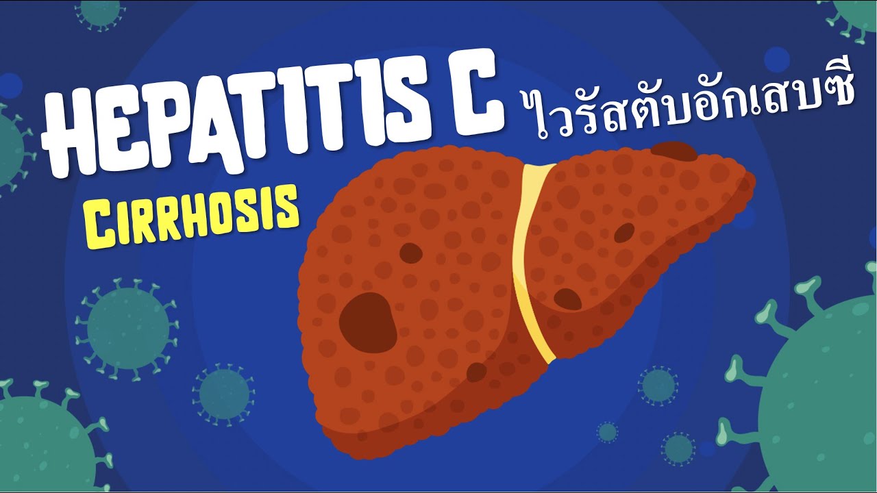 Hepatitis C & Cirrhosis // โรคไวรัสตับอักเสบซีและภาวะตับแข็ง : อาการ การรักษา