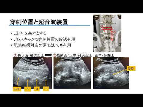 医学科 ①無痛分娩の実際_金沢路子_第10回産科麻酔に参加しよう