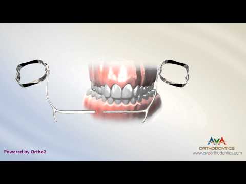 Orthodontic Expander or Spacer - E Arch Appliance